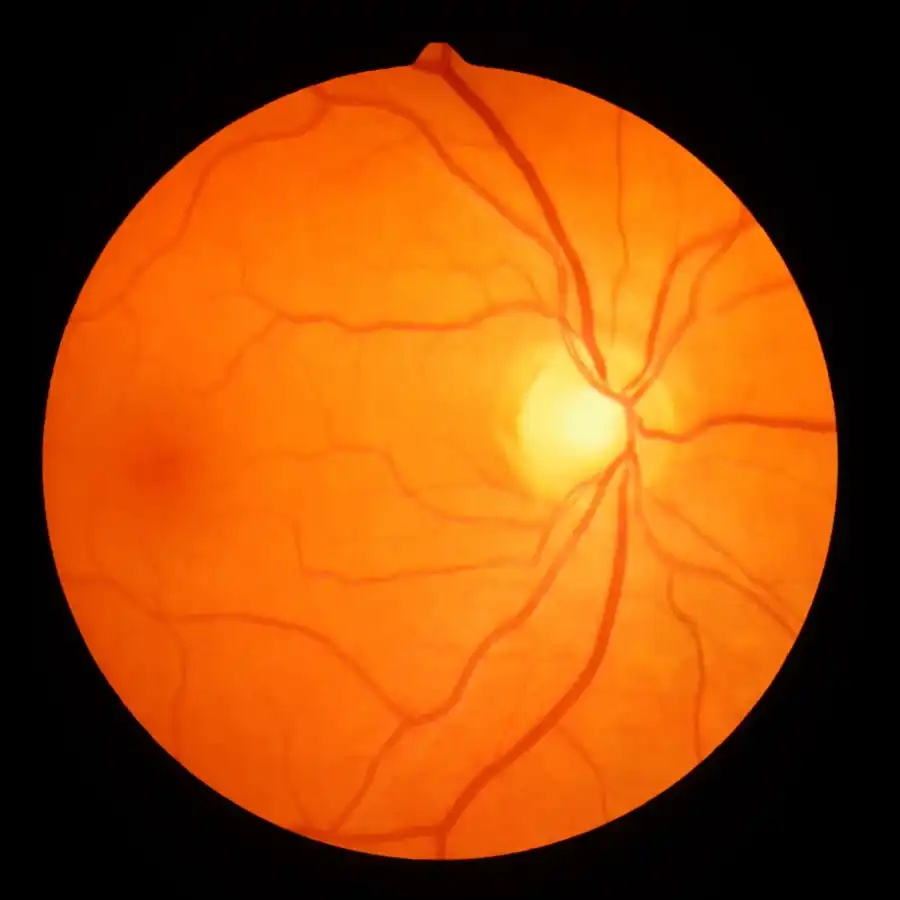 Retinal imaging for a diabetic eye exam at Cedar Valley Eyecare